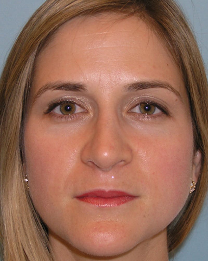 Rhinoplasty  Before & After Gallery - Patient 189212 - Image 4
