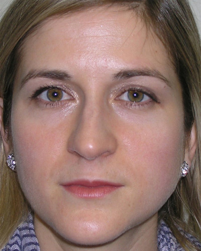 Rhinoplasty  Before & After Gallery - Patient 189212 - Image 3