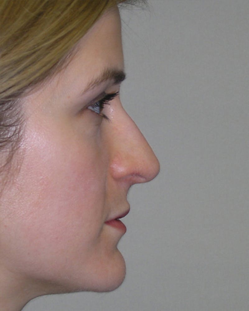 Patient dVs_cYfiSKSLAgjiwTXitg - Rhinoplasty Before & After Photos