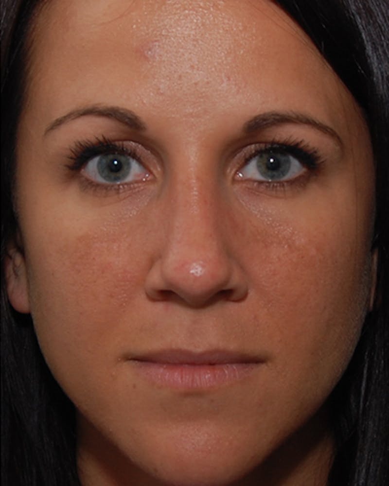 Rhinoplasty  Before & After Gallery - Patient 151830 - Image 7