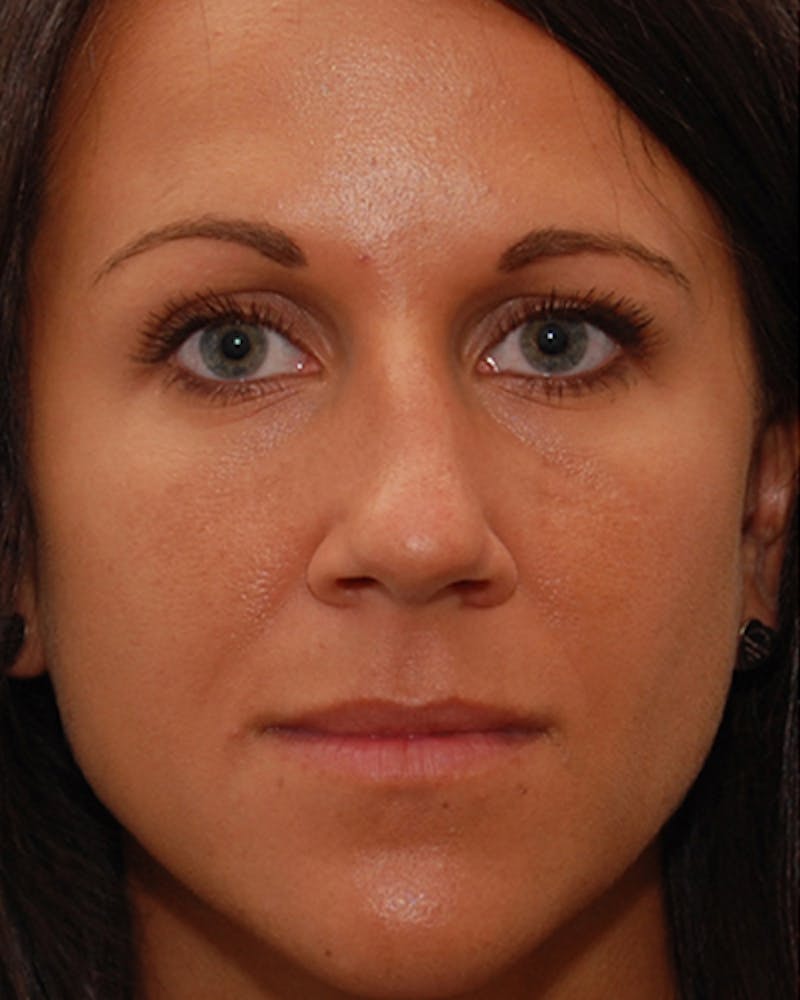 Rhinoplasty  Before & After Gallery - Patient 151830 - Image 8