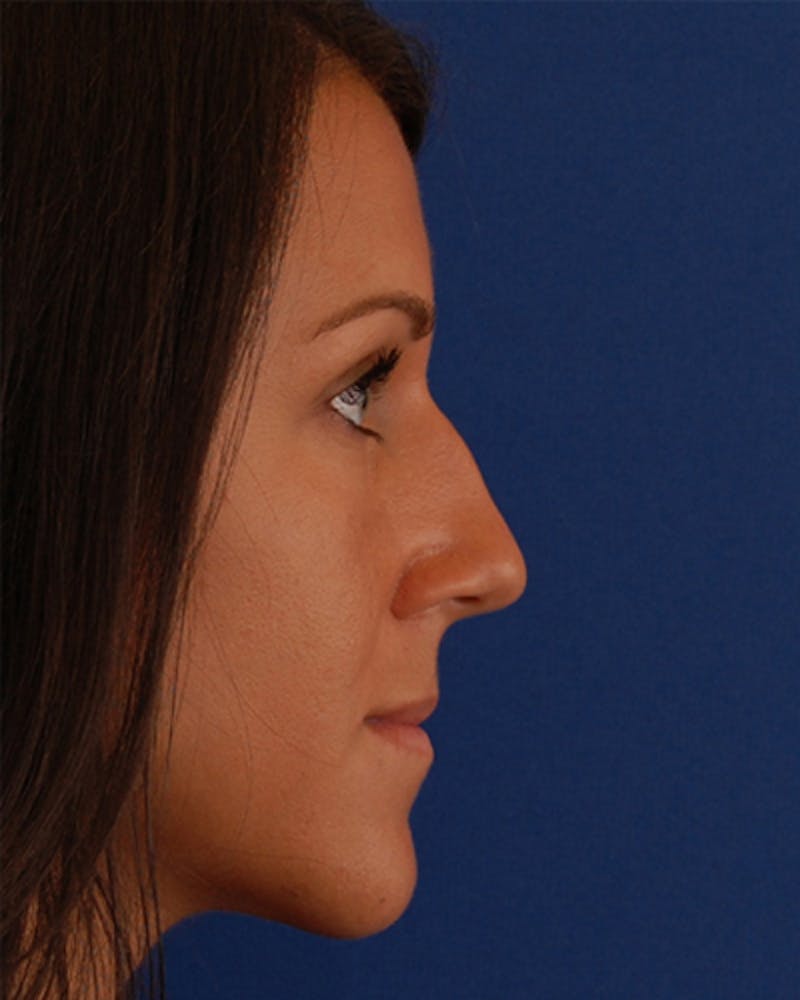 Patient Nuw5mrwITbCClAKUX3a_WA - Rhinoplasty Before & After Photos