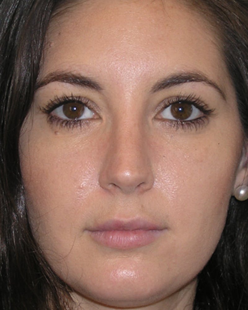 Favorite Rhinoplasty Before & After Gallery - Patient 296440 - Image 6
