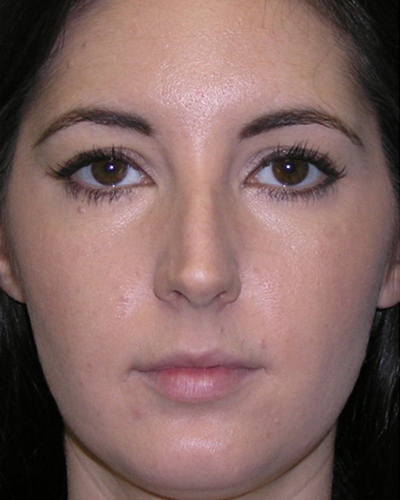 Favorite Rhinoplasty Before & After Gallery - Patient 296440 - Image 5