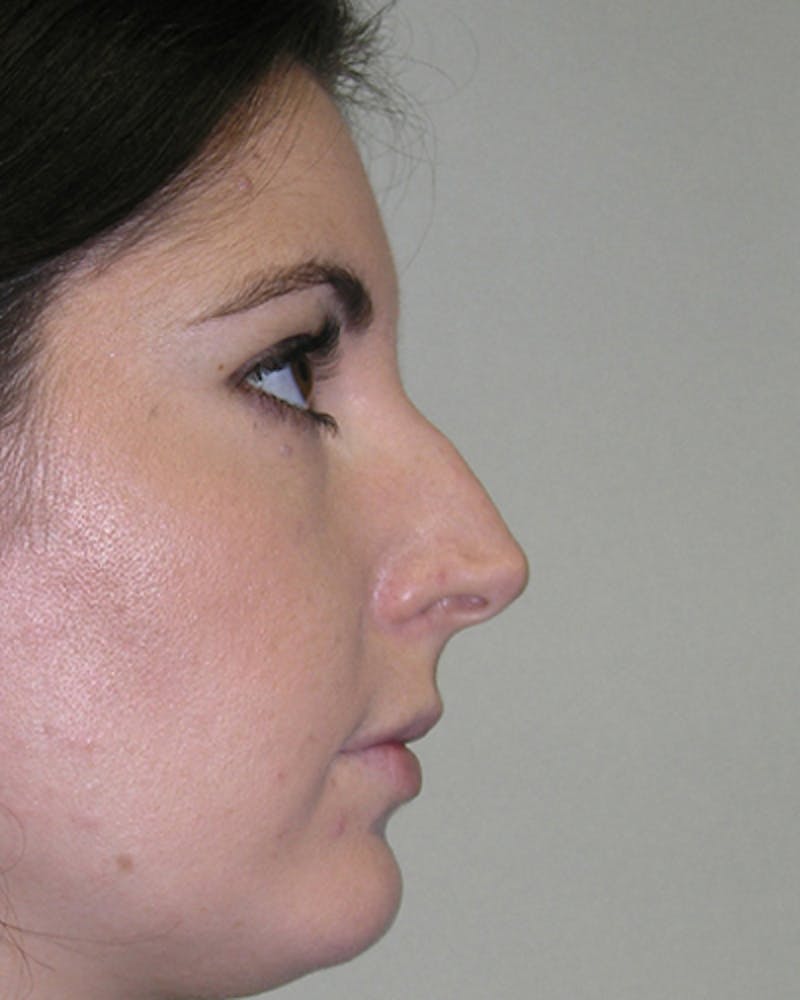 Patient QfpIH9gTSA6ykmOWcu4I1g - Rhinoplasty Before & After Photos