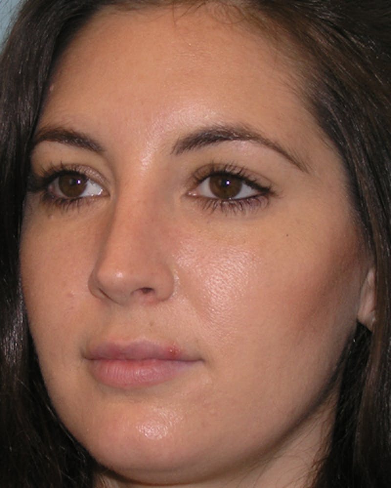 Favorite Rhinoplasty Before & After Gallery - Patient 296440 - Image 4