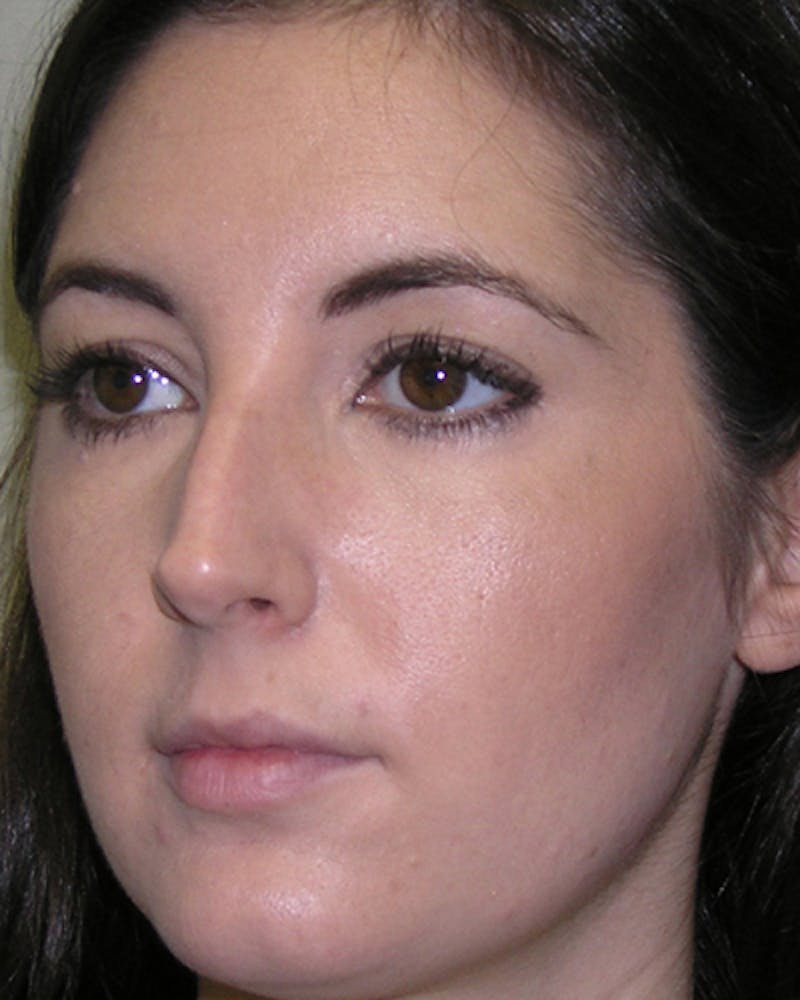 Favorite Rhinoplasty Before & After Gallery - Patient 296440 - Image 3
