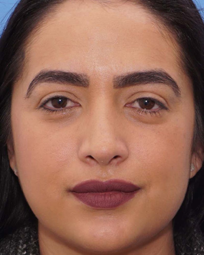 Rhinoplasty  Before & After Gallery - Patient 197923 - Image 4