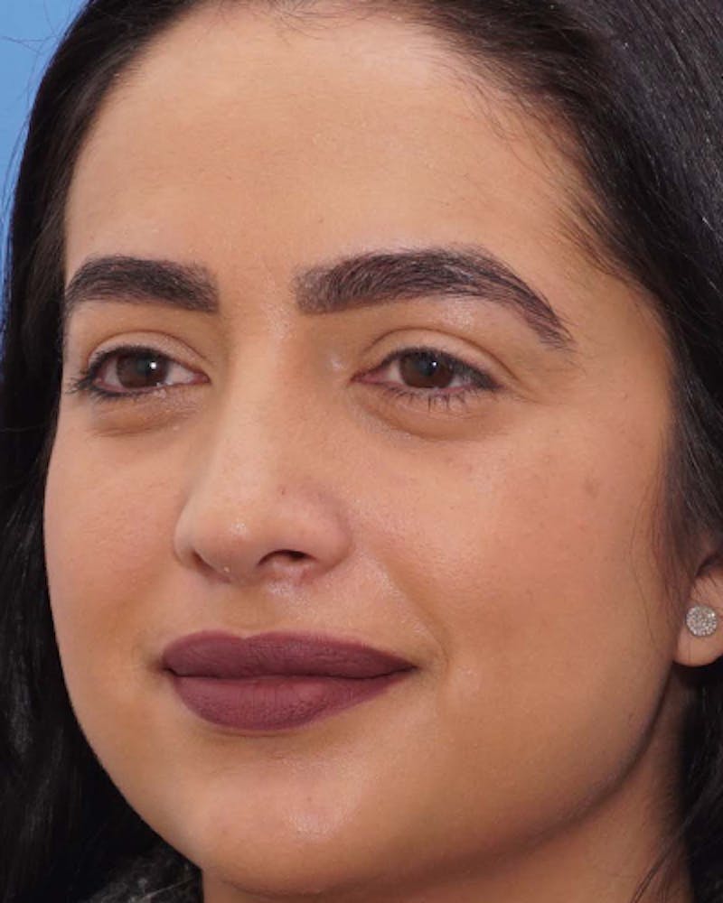 Rhinoplasty  Before & After Gallery - Patient 197923 - Image 6