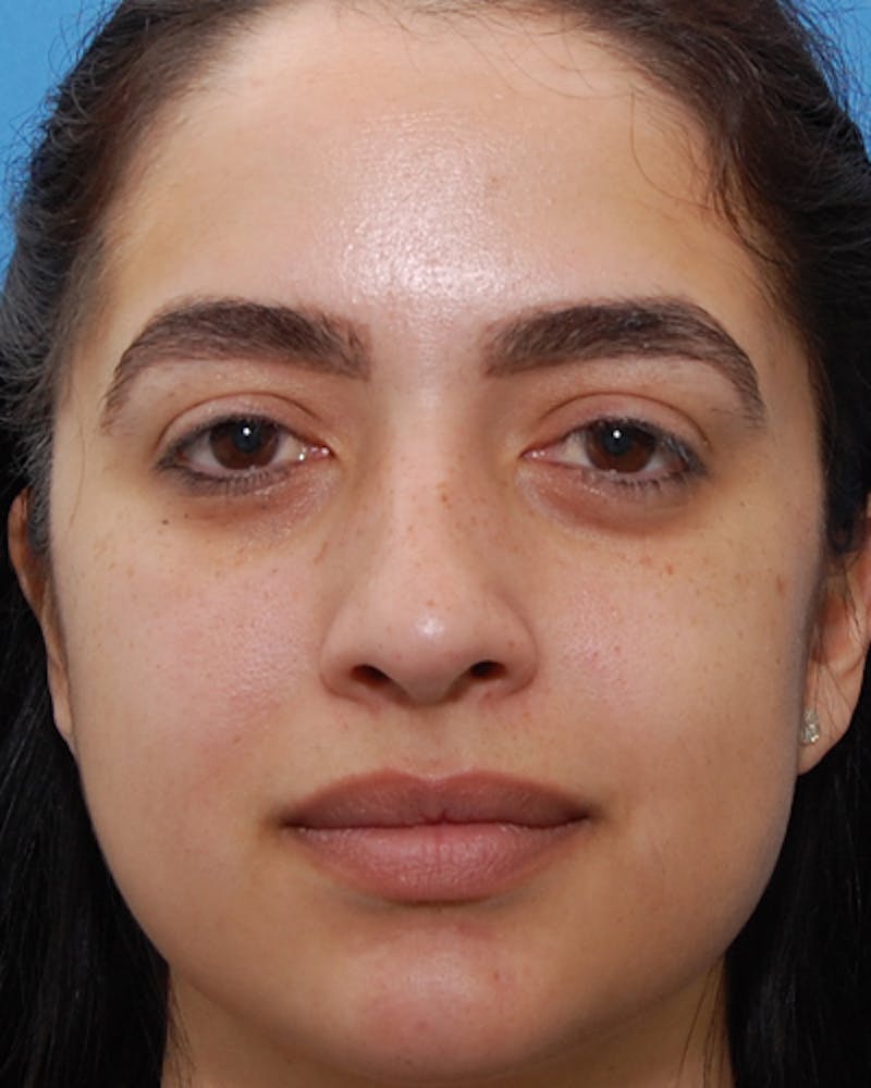 Rhinoplasty  Before & After Gallery - Patient 197923 - Image 3