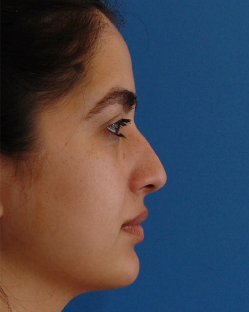 Patient O9an2OUoSrm7rVwfuWQW0w - Rhinoplasty Before & After Photos