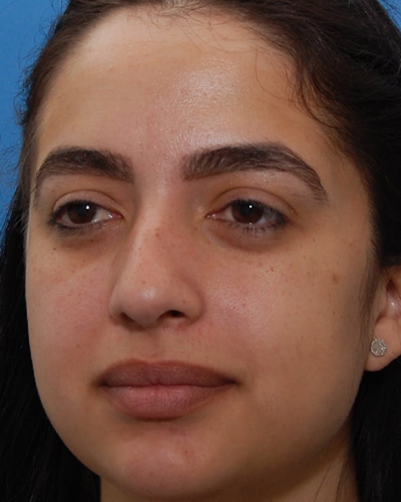 Rhinoplasty  Before & After Gallery - Patient 197923 - Image 5