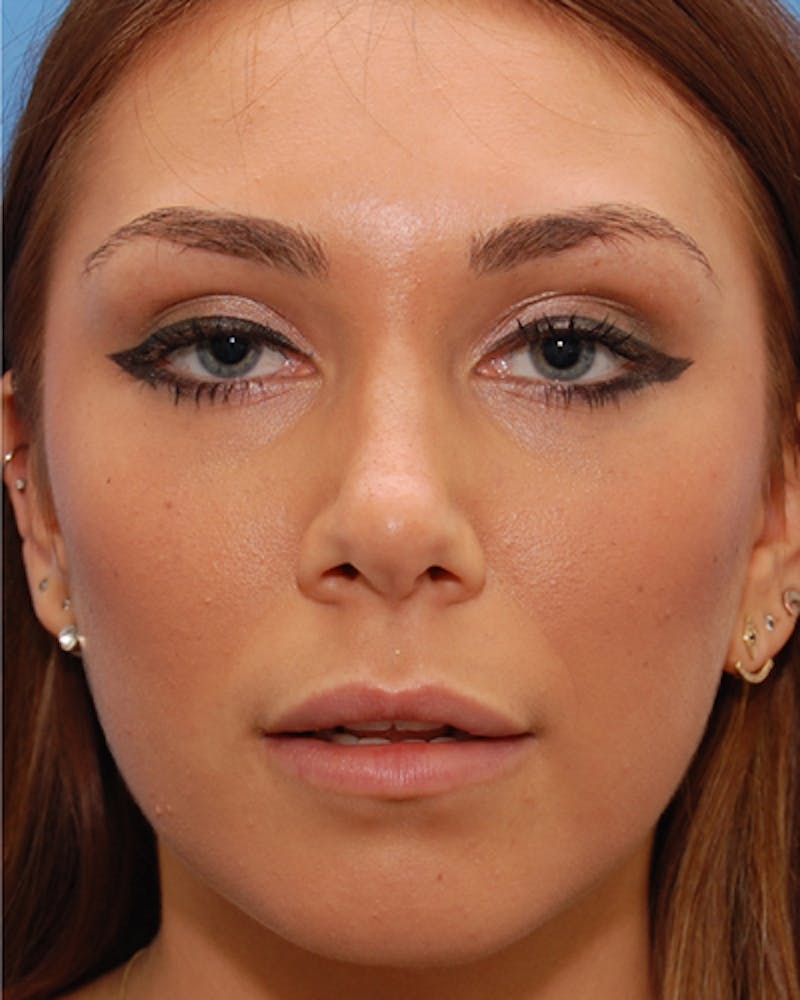 Rhinoplasty  Before & After Gallery - Patient 259439 - Image 4