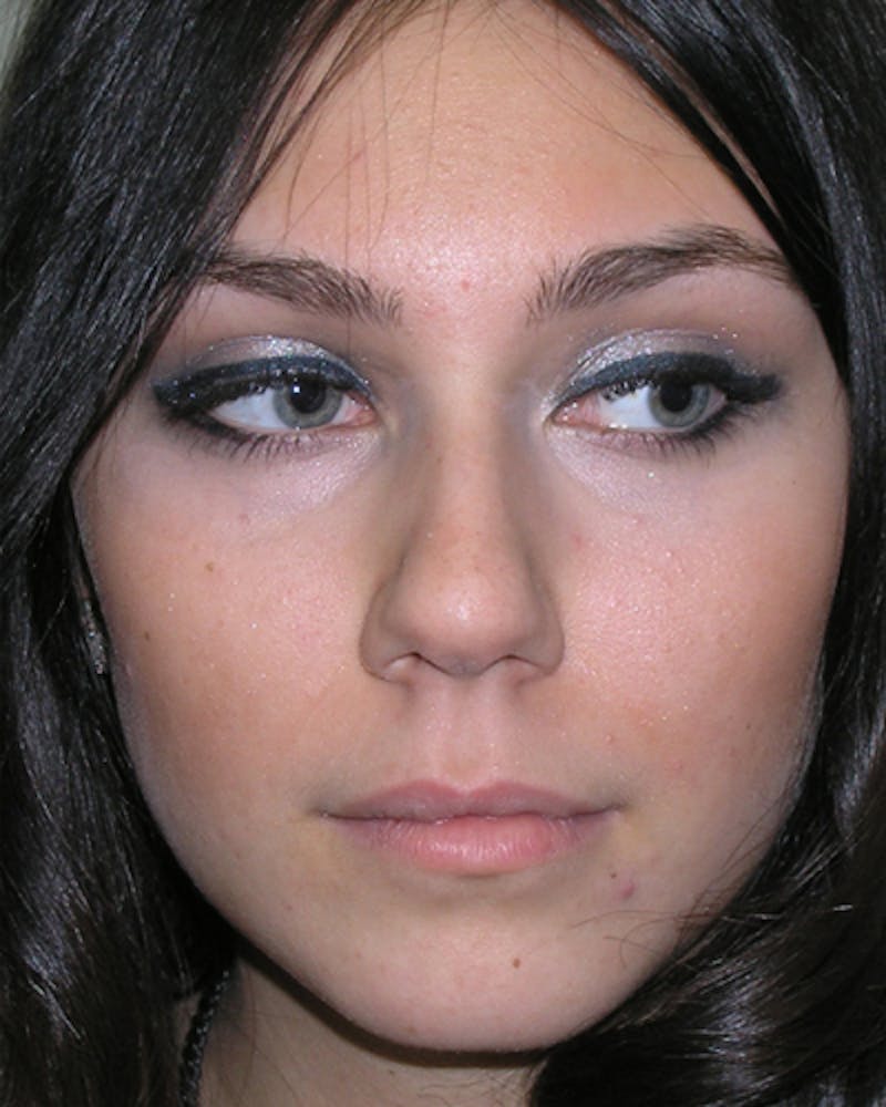 Rhinoplasty  Before & After Gallery - Patient 259439 - Image 3