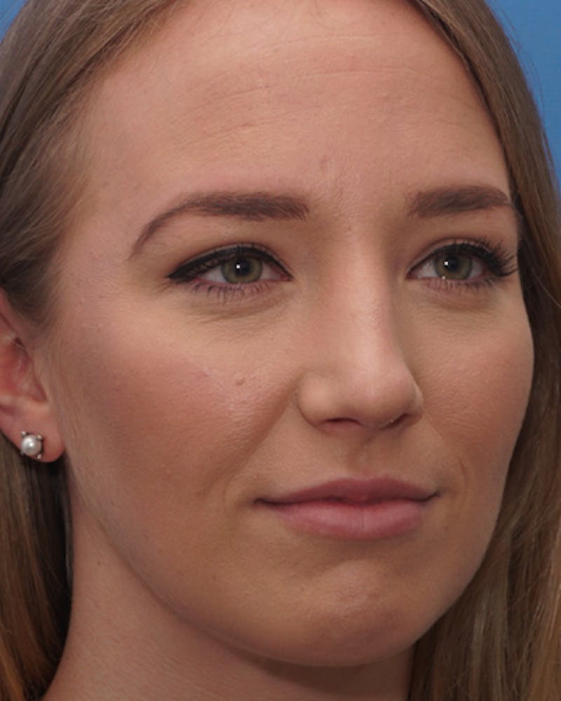 Rhinoplasty  Before & After Gallery - Patient 615536 - Image 6