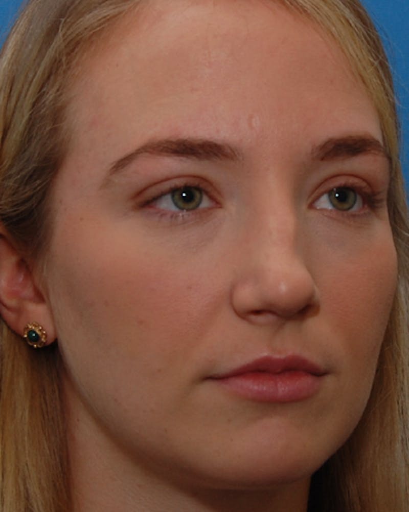 Rhinoplasty  Before & After Gallery - Patient 615536 - Image 5