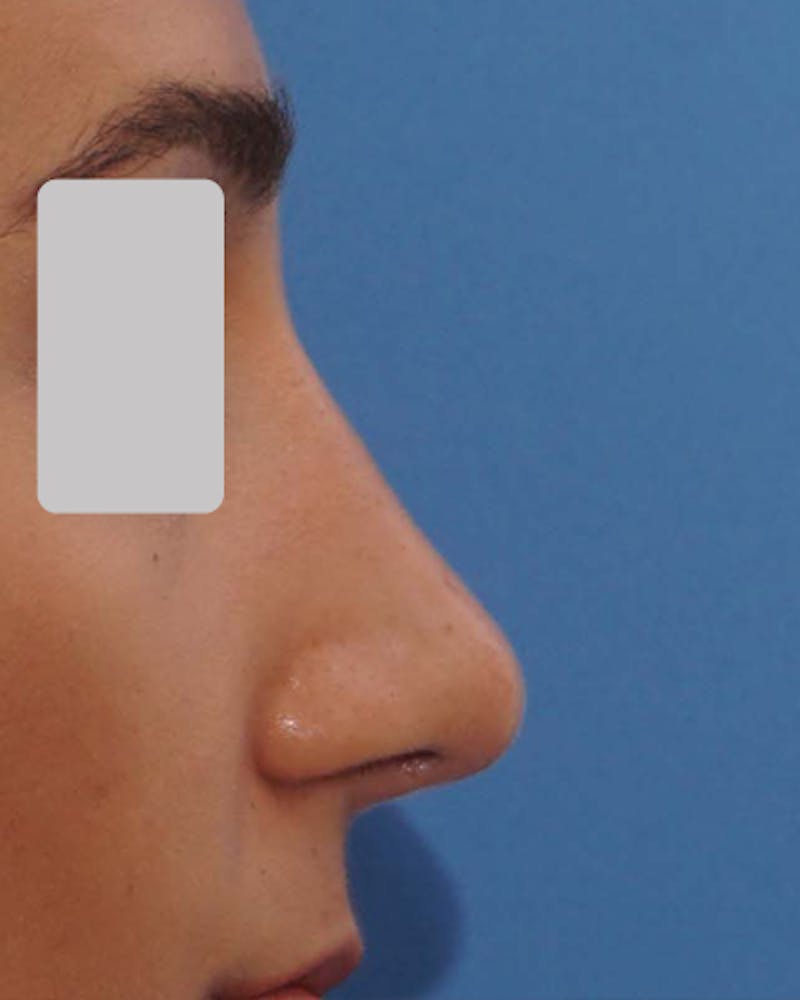 Rhinoplasty  Before & After Gallery - Patient 182505 - Image 6