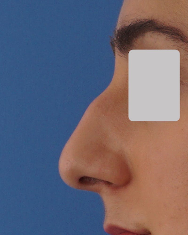 Patient TY6SGJ88TDe7poo5t0zAqw - Rhinoplasty Before & After Photos