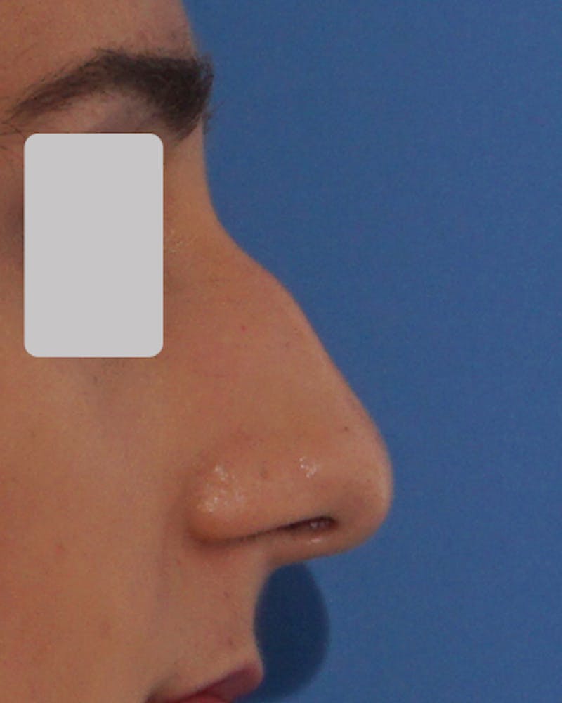 Rhinoplasty  Before & After Gallery - Patient 182505 - Image 5