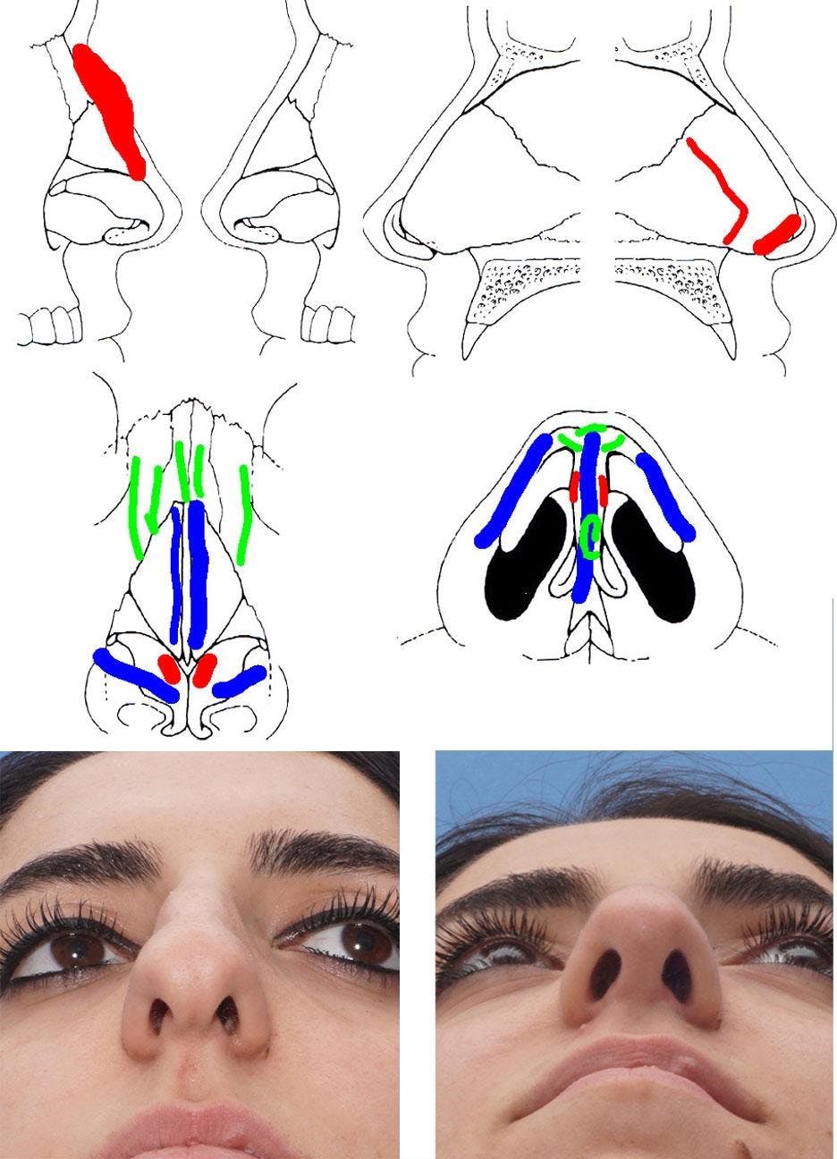 Seeing through the Envelope: The Cartilage Shape Requirements for an Aesthetically Pleasing Nasal Tip (2020)