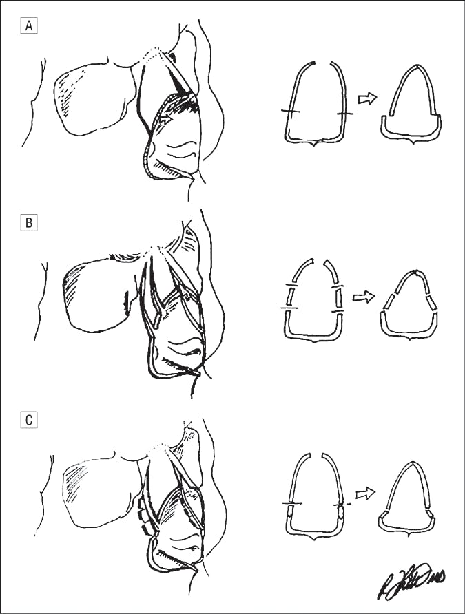 Perforating Double Lateral Osteotomy (2005)