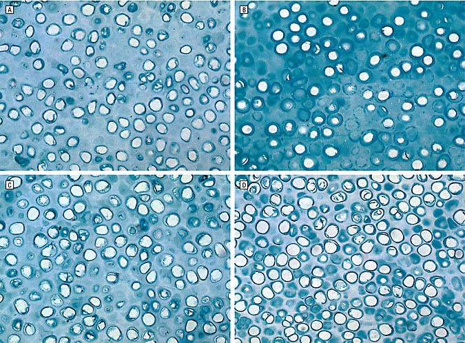 Autologous cartilage grafts enhanced by a novel transplant medium using fibrin sealant and fibroblast growth factor (2004)