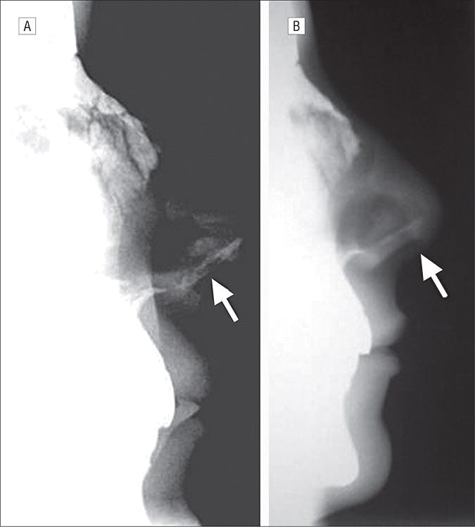 Augmentation of nasal tip projection using the inferior turbinate: review of technique and evaluation of long-term success (2008)
