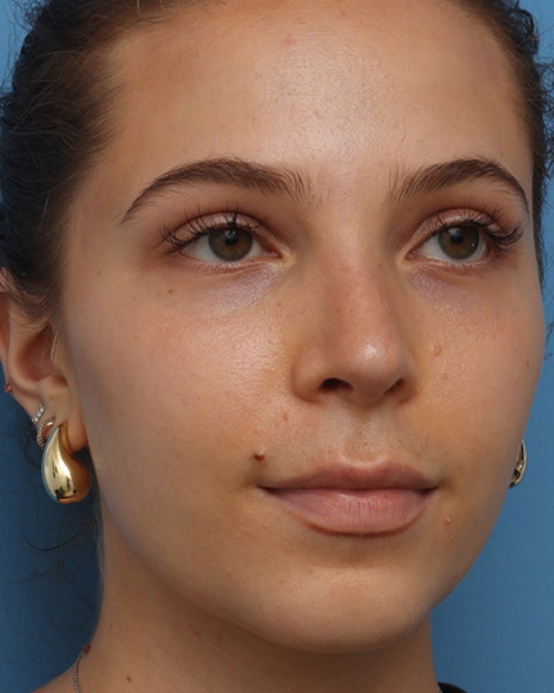 Favorite Rhinoplasty Before & After Gallery - Patient 219633 - Image 8