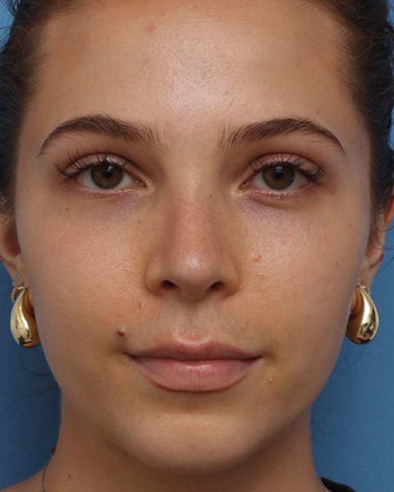 Favorite Rhinoplasty Before & After Gallery - Patient 219633 - Image 6