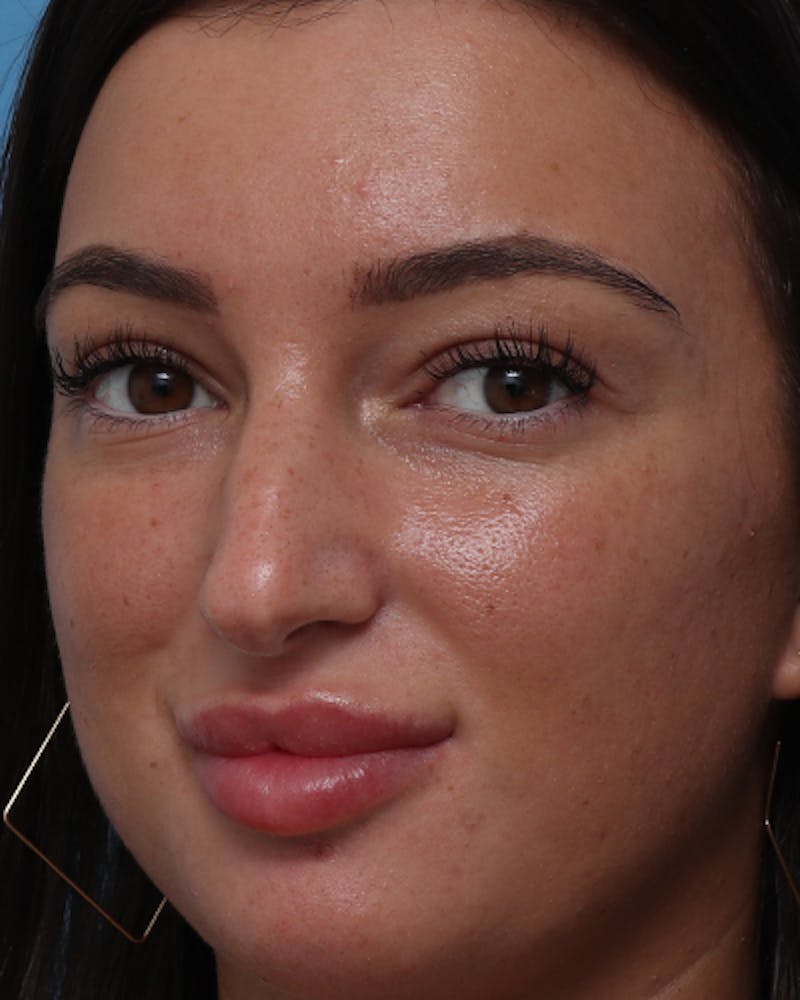 Rhinoplasty  Before & After Gallery - Patient 238093 - Image 7