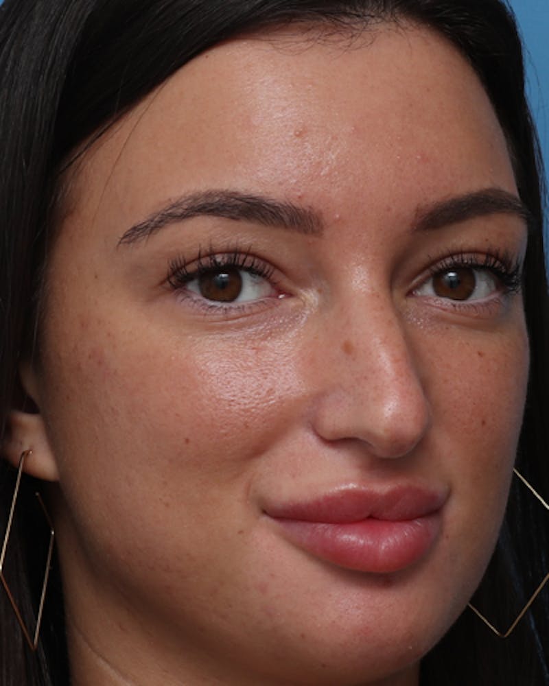 Rhinoplasty  Before & After Gallery - Patient 238093 - Image 5