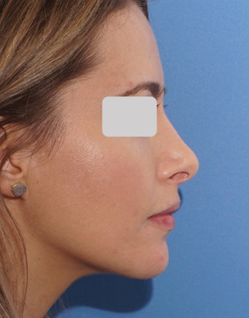 Patient E3RRlxKBTE6vkVivWyveBw - Revision Rhinoplasty Before & After Photos