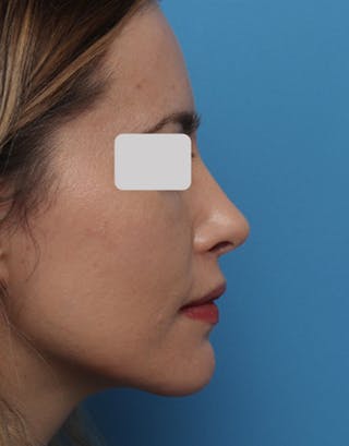 Favorite Revision Rhinoplasty Before & After Gallery - Patient 292560 - Image 2