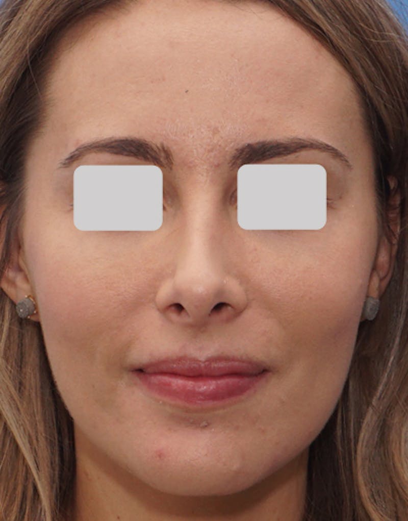 Favorite Revision Rhinoplasty Before & After Gallery - Patient 292560 - Image 3