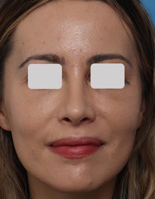 Favorite Revision Rhinoplasty Before & After Gallery - Patient 292560 - Image 4