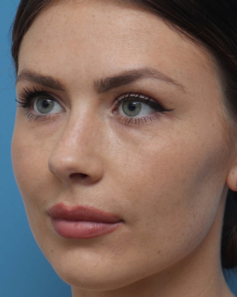 Rhinoplasty  Before & After Gallery - Patient 329477 - Image 4