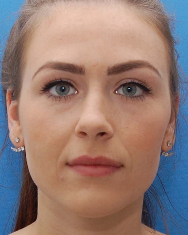 Patient OeqY5RPWTiC0WIKyZfInRA - Revision Rhinoplasty Before & After Photos