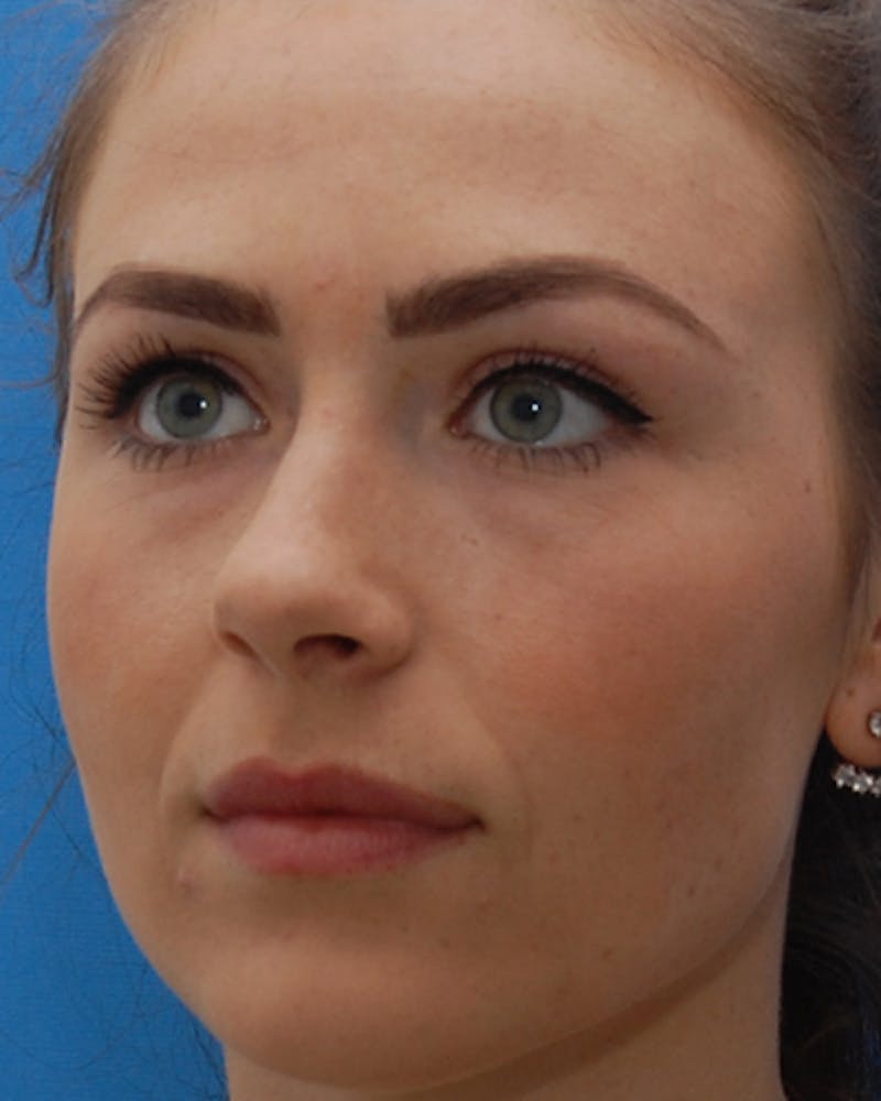 Rhinoplasty  Before & After Gallery - Patient 329477 - Image 3