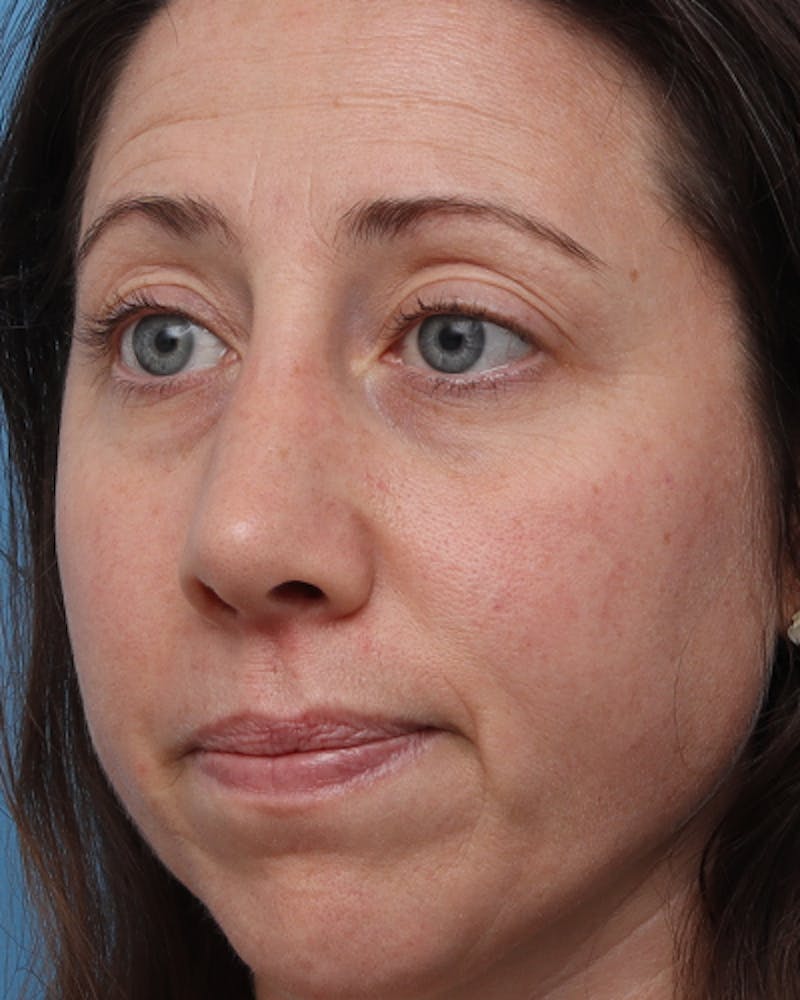 Rhinoplasty  Before & After Gallery - Patient 358221 - Image 7