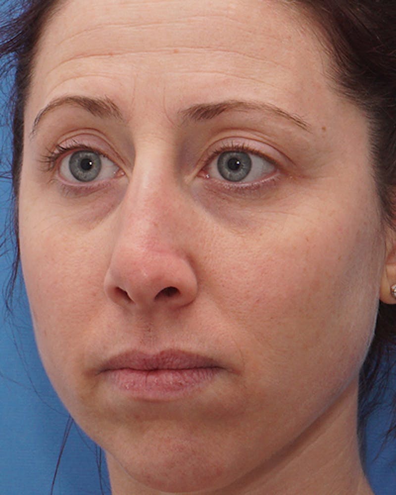 Rhinoplasty  Before & After Gallery - Patient 358221 - Image 8