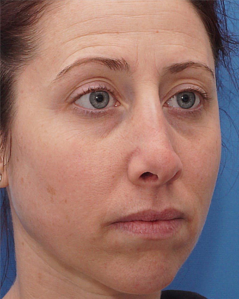 Patient U55L1YgbS-Gy0tFUTCIL0Q - Revision Rhinoplasty Before & After Photos