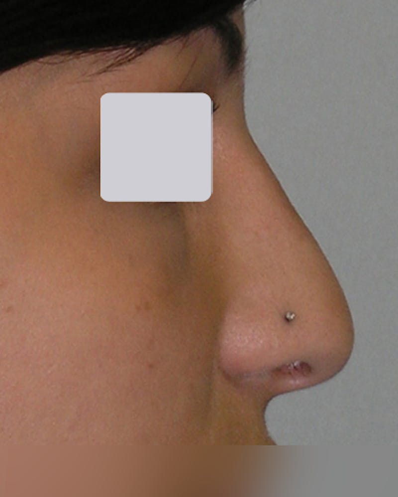 Rhinoplasty  Before & After Gallery - Patient 122481 - Image 3
