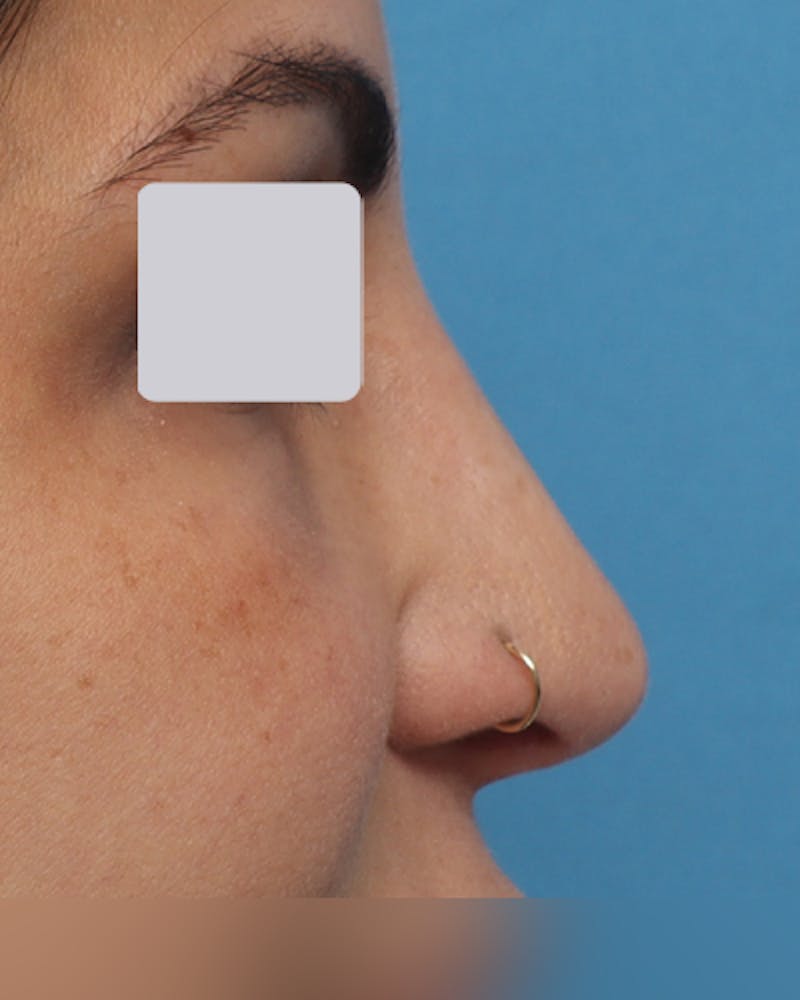 Rhinoplasty  Before & After Gallery - Patient 122481 - Image 4