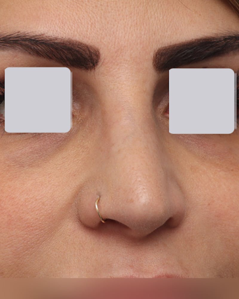 Rhinoplasty  Before & After Gallery - Patient 122481 - Image 6