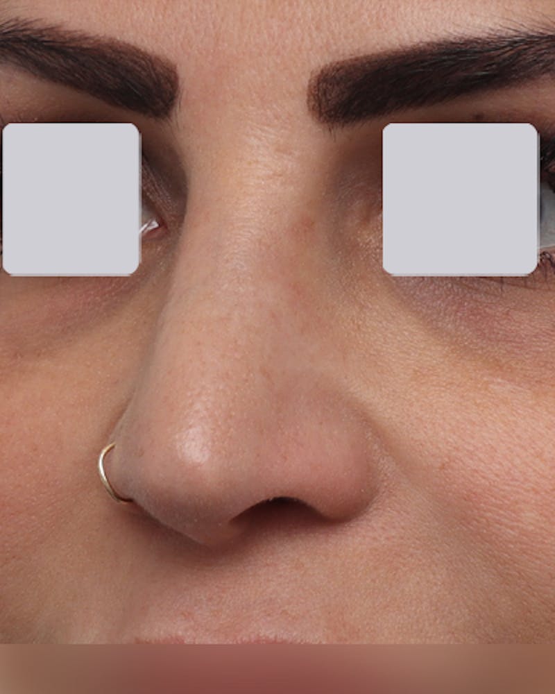 Rhinoplasty  Before & After Gallery - Patient 122481 - Image 8