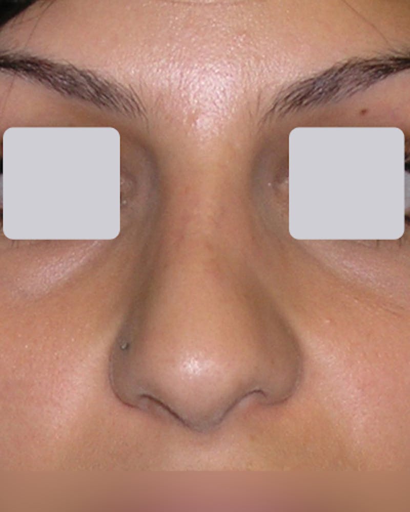 Patient WlNDJRTPQl-z0pz4xiyjXw - Revision Rhinoplasty Before & After Photos