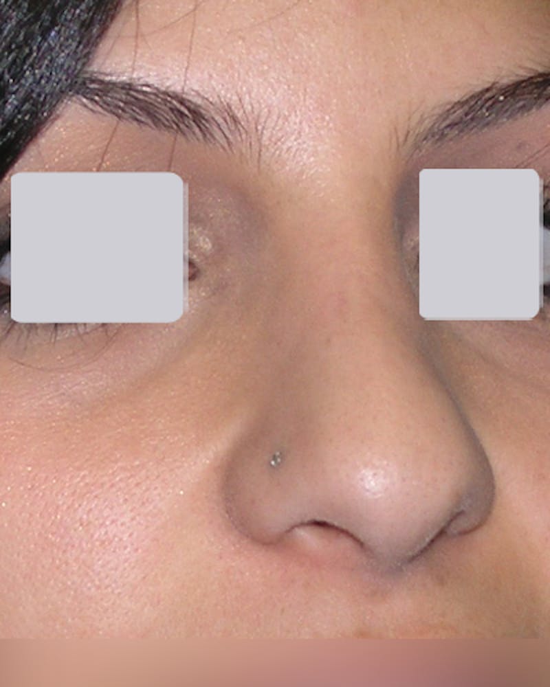 Rhinoplasty  Before & After Gallery - Patient 122481 - Image 5