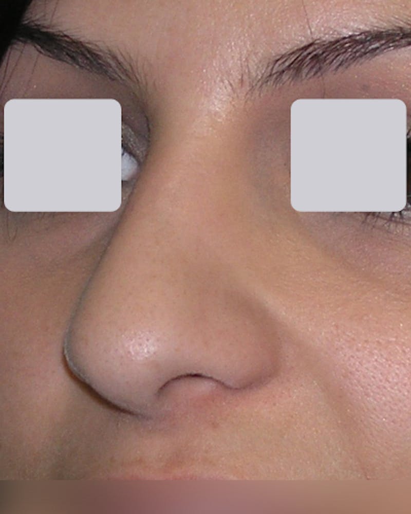 Rhinoplasty  Before & After Gallery - Patient 122481 - Image 7