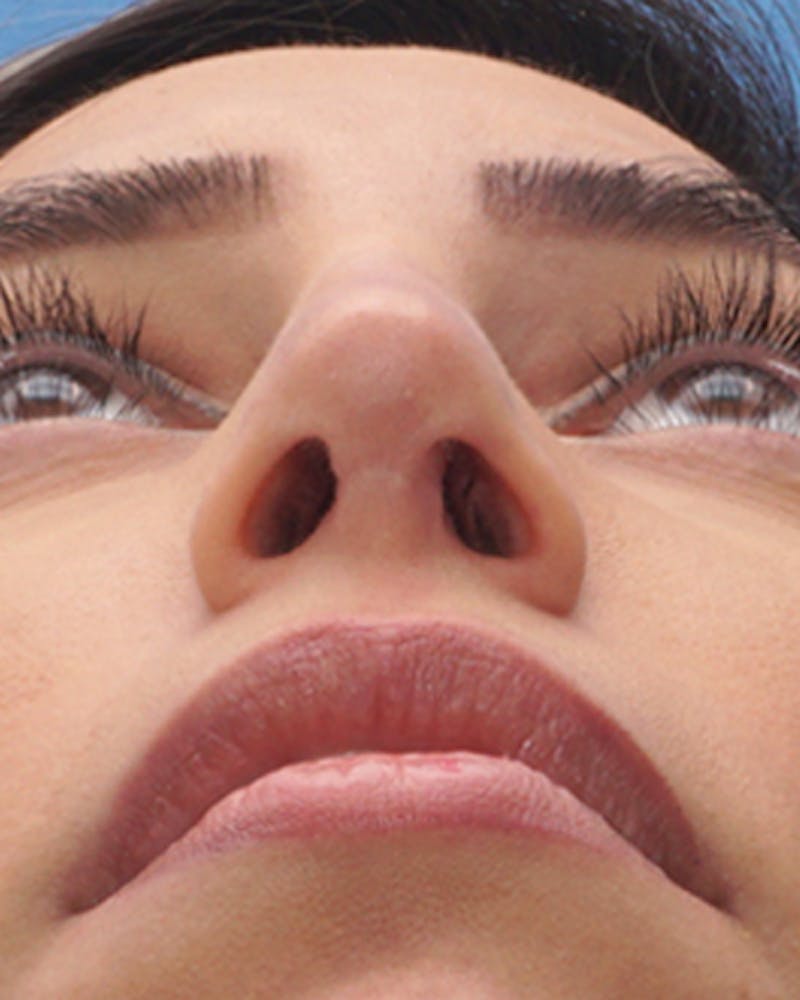 Favorite Revision Rhinoplasty Before & After Gallery - Patient 155140 - Image 8