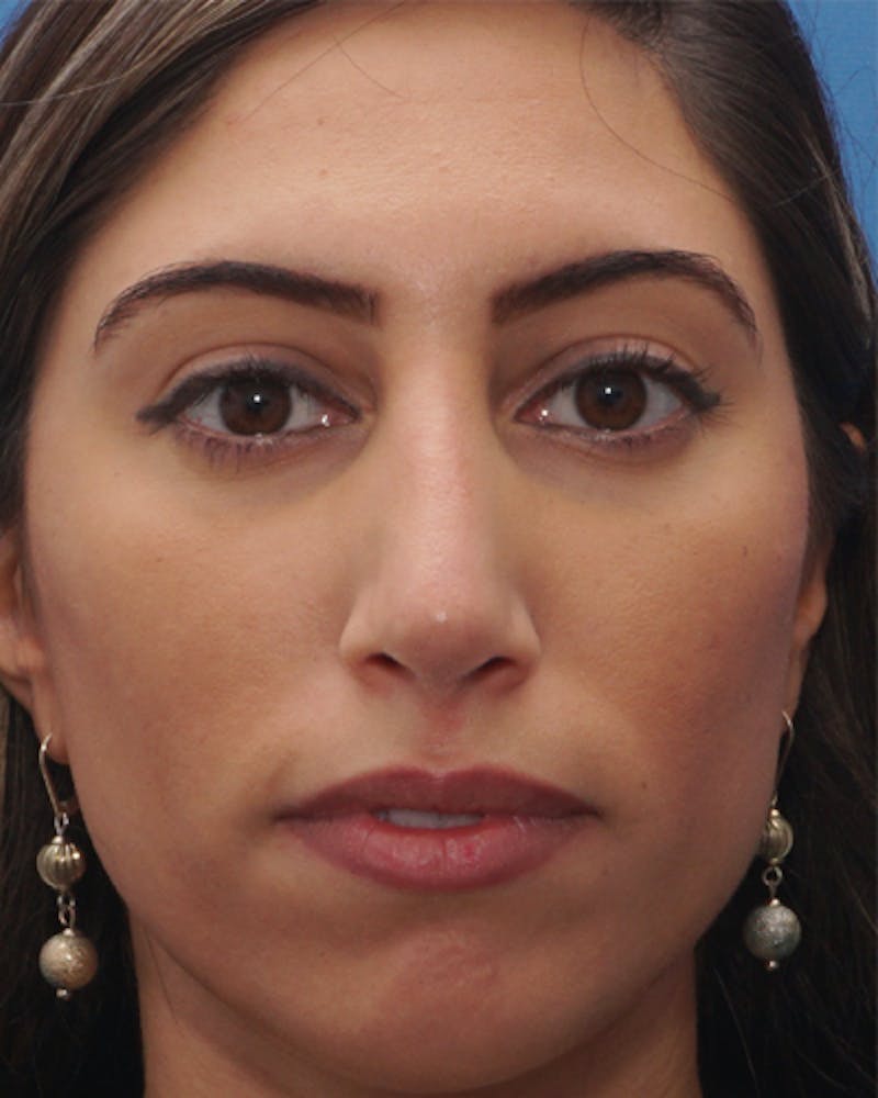 Favorite Revision Rhinoplasty Before & After Gallery - Patient 155140 - Image 6